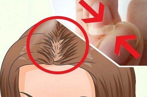 plaukų ir nagų problemos su parazitais