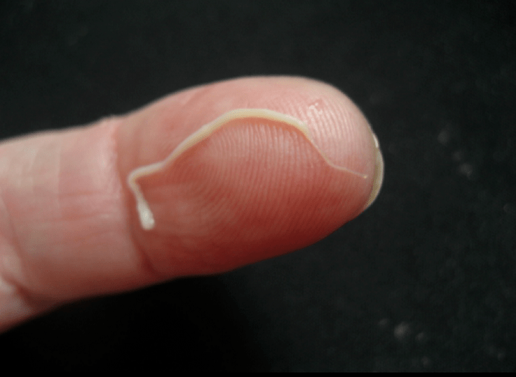 apvaliųjų kirmėlių parazitas iš žmogaus kūno